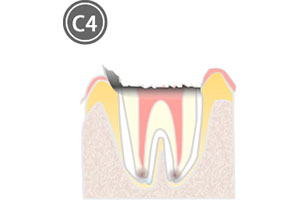 虫歯_c1